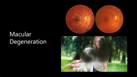 Macular Degeneration Its Cause Treatment And Symptoms