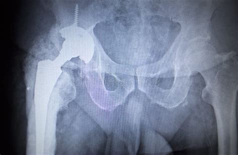 X Ray Orthopedic Scan Image Of Hip Joints Human Skeleton Stock Photo