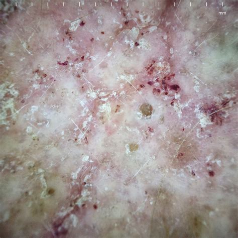 Virtual Grand Rounds In Dermatology 20 Norwegian Scabies Infestation