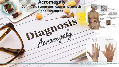 acromegaly a comprehensive guide to symptoms diagnosis and treatment
