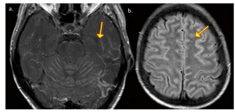 Cryptococcosis Meningitis A T1 Axial Post Contrast Evidencing The