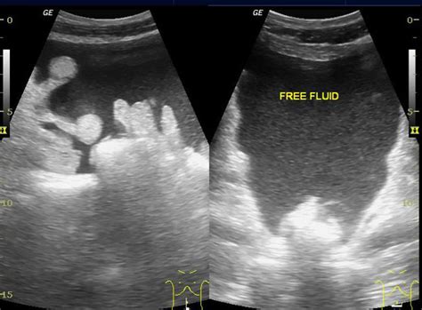 Ascites Ultrasound Wikidoc