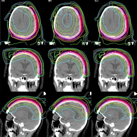 Volumetric Modulated Arc Radiotherapy Treatment Plan Patient 1 A