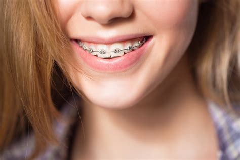 Understanding The Different Types Of Braces Every Smile Dental