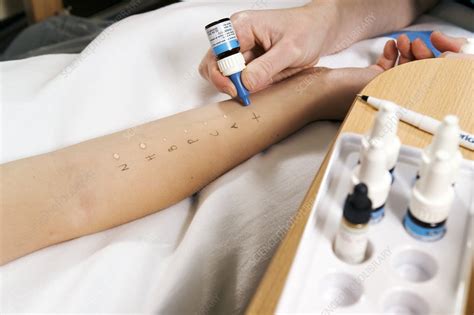 Allergy Test Stock Image M3200382 Science Photo Library