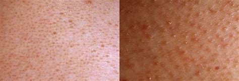 Do You Have Small Red Bumps On Your Upper Arms Memorable Days