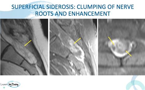 Superficial Siderosis Of The Spine What To Look For Radedasia