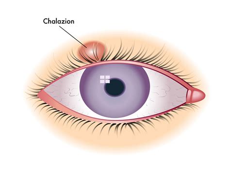 Chalazion Cause Duration Photo Treatment Encysted