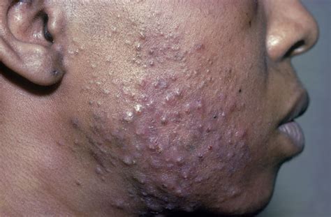Microneedling To Treat Acne Scars In Patients With Dark Skin Color Dermatology Advisor