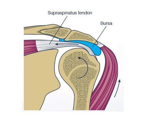 Shoulder Impingement Relief Innova Wellness Expert Care For Shoulder