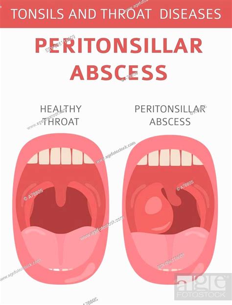 Tonsils And Throat Diseases Peritonsillar Abscess Symptoms Treatment Icon Set Stock Vector