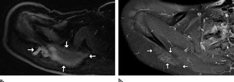 Desmoid Type Fibromatosis Overlying The Right Trapezius Muscle In A