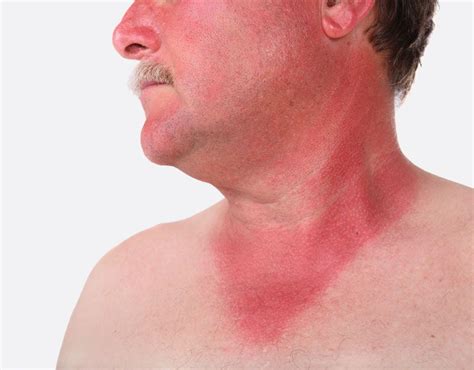 Sunburn Uv Rays Sun Damage And Prevention Britannica