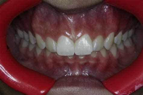 Braces are effective for treating most overbite problems. Narrow arch Results in Crowding and a Narrow Smile - Align ...