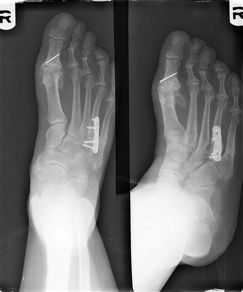 Treatment Of Fourth Metatarsal Base Fracture Non Unions In Middle Aged