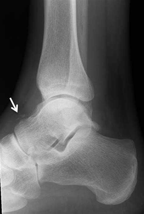 talus avulsion fractures   accurately diagnosed