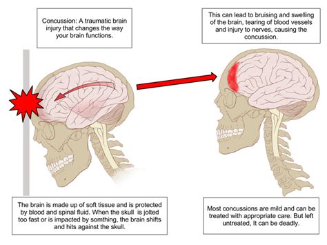 Difference Between Concussion And Contusion Compare The Difference