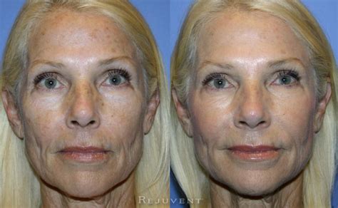 Aging Skin • Rejuvent Medical Spa Scottsdale
