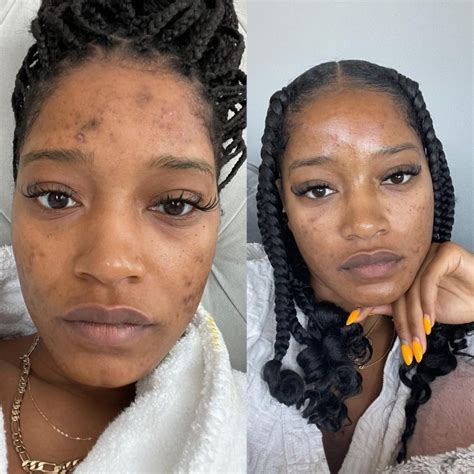 keke palmer shares her skin progress that she achieved by herself by discovering the best acne