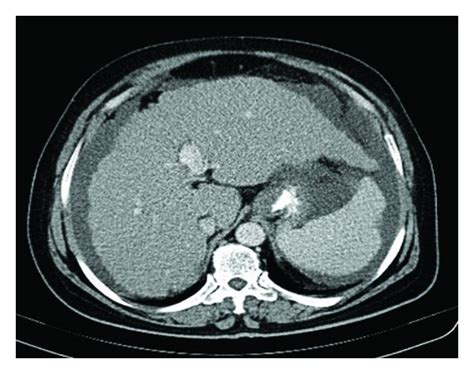 Abdominal Ct Scan Showed A Cirrhotic Liver Splenomegaly And Ascites