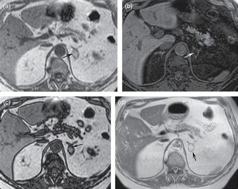 Magnetic Resonance Imaging Of The Adrenal Gland Obgyn Key