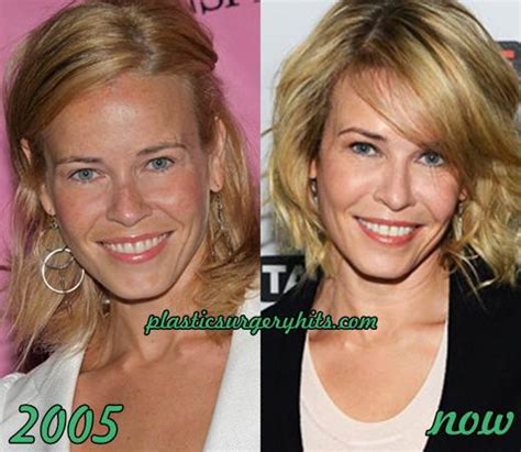 Chelsea Lately Plastic Surgery Before After