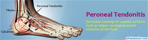 Peroneal Tendonitis Or Peroneal Tendinitiscausessymptomstreatment