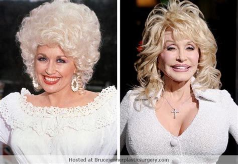 Dolly Parton Plastic Surgery Bob Job Done Before After Dolly Parton