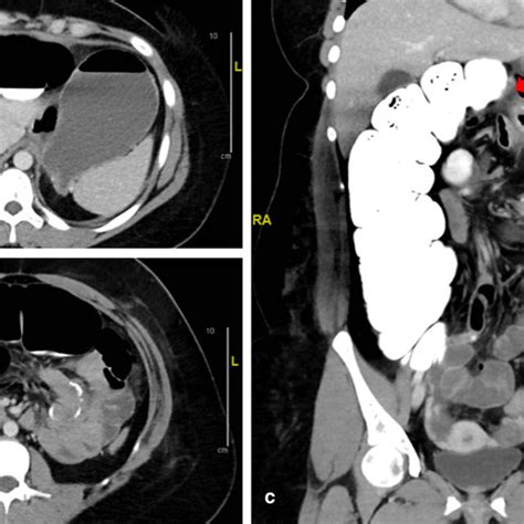 Abdominal Computed Tomography Scan On The Fourth Postoperative Day