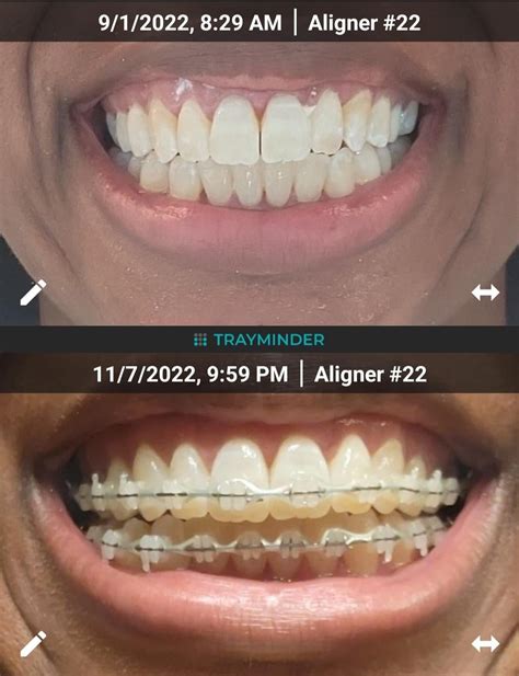 Aligners For 2 Years Braces For 3 Months Rbraces