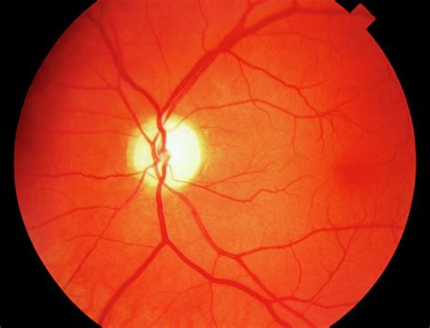 Ophthalmoscope View Of Retina With Optic Atrophy Photograph By Sue Ford