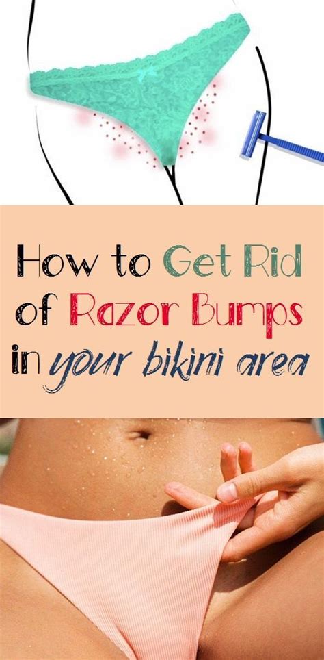 How to get rid of woodlice on cactus: How to Get Rid of Razor Bumps in 2020 | Skin bumps, Razor ...