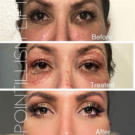 Botox For Hooded Eyelids Before And After