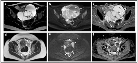 JCM Free Full Text Diffusion Weighted Magnetic Resonance Imaging In Ovarian Cancer