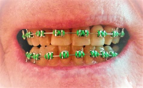 Pin By John Beeson On Orthodontic Braces Orthodontics Braces Orthodontics Braces