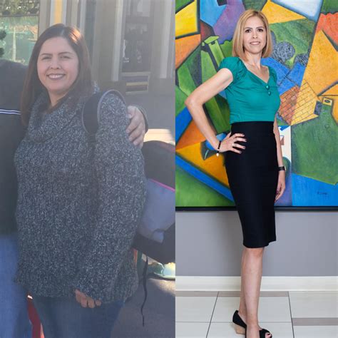 weight loss surgery before and after photos soma bariatrics los angeles