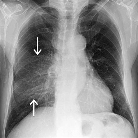 Imaging Evaluation Of Malignant Chest Wall Neoplasms Radiographics