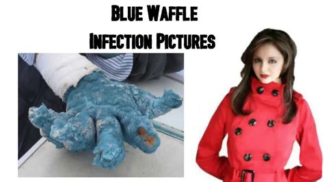 Blue Waffle Pussy Images Telegraph