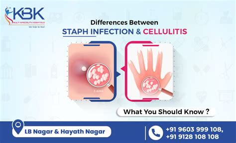 Staph Infection And Cellulitis Know The Differences