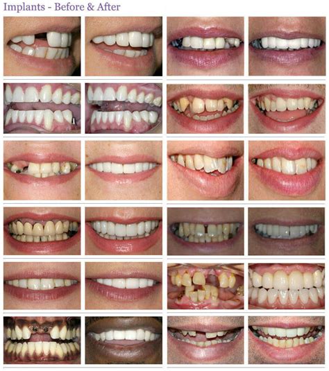 Pictures of teeth implants you need to check because these are the common cases implant teeth before and after to note what? Photographic Gallery Archives of Implant Patients - The ...