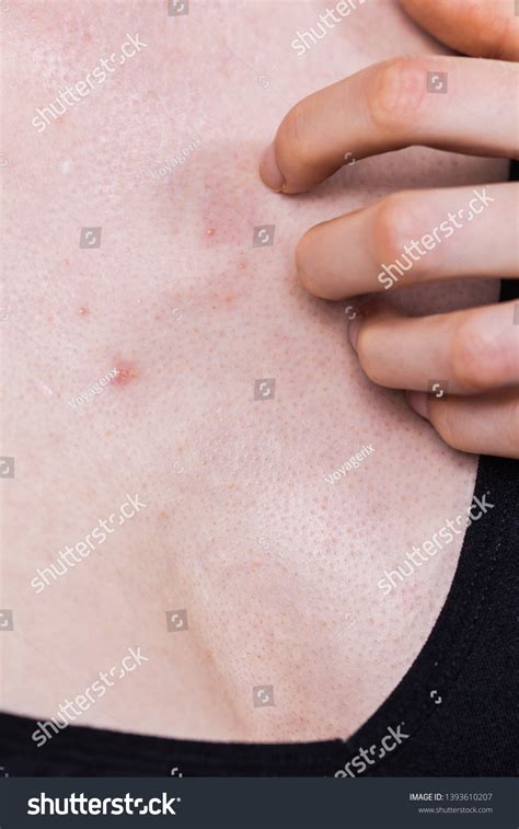 Woman Having Pimples Red Spots On Stock Photo 1393610207 Shutterstock