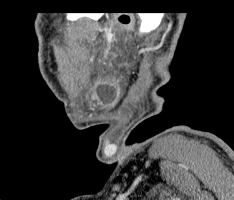 First Branchial Cleft Cyst Image
