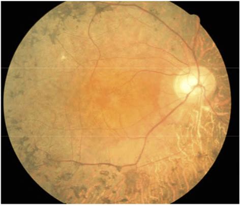 Fundus Photograph Of The Rp Patient Fundus Photograph Of The Right Eye