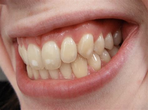 0 Result Images Of Little Black Spots On Teeth Png Image Collection