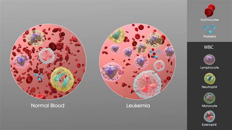Leukemia Types Causes Symptoms Diagnosis Treatment Prevention