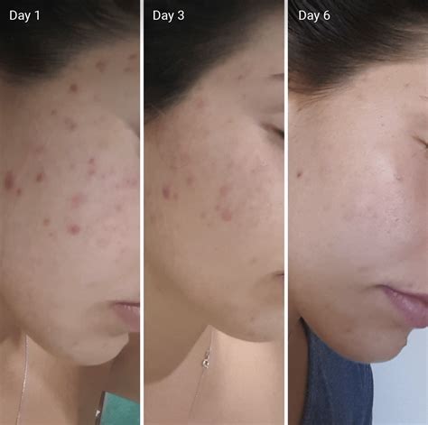 The Power Of Vitamin C On Acne Scars A Comprehensive Guide Martlabpro