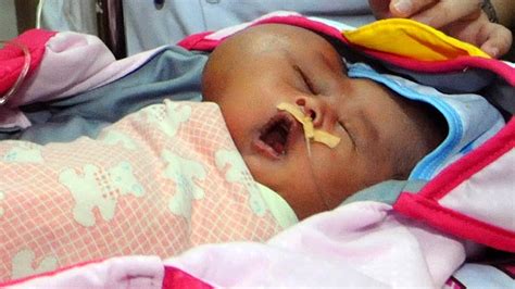 Baby Born With Huge Facial Tumour In Indonesia Youtube