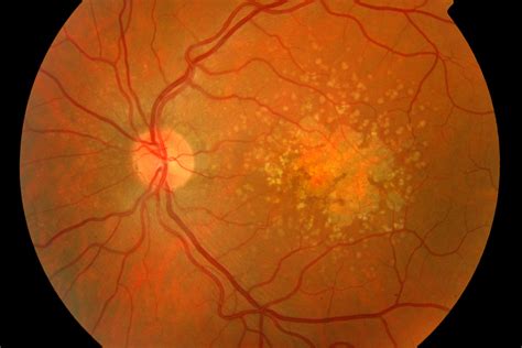 Age Related Macular Degeneration Amd Types Causes And