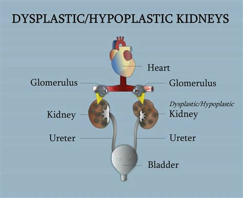 Dysplastichypoplastic Kidneys Youtube