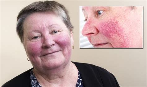Rosacea Red Face Best Treatment For The Long Term Skin Condition